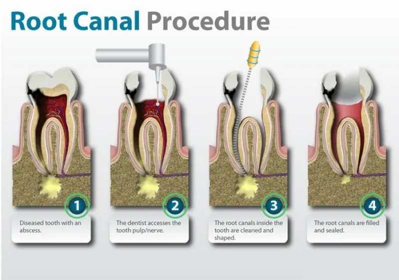 Root Canal Treatment Single Sitting