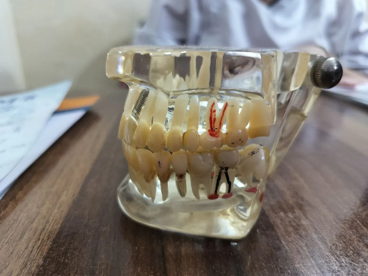 Dental Implant Model