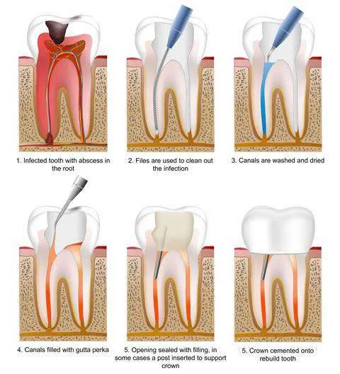 Painless Root Canal Treatment