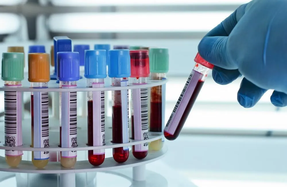 Anti Mullerian Hormone (AMH)