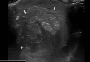 SCROTUM / THYROID / EYE