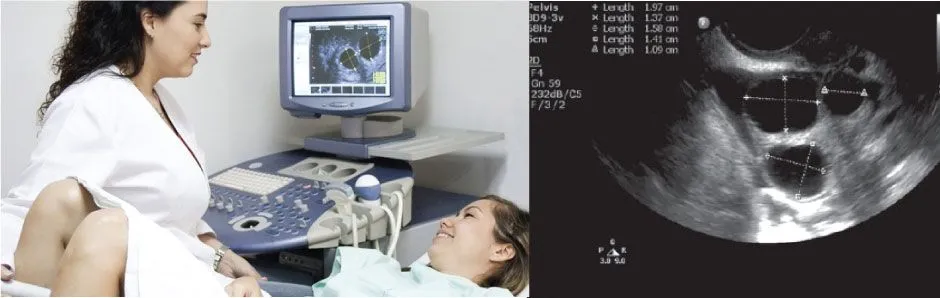 OVULATION / FOLLICULAR MONITORING
