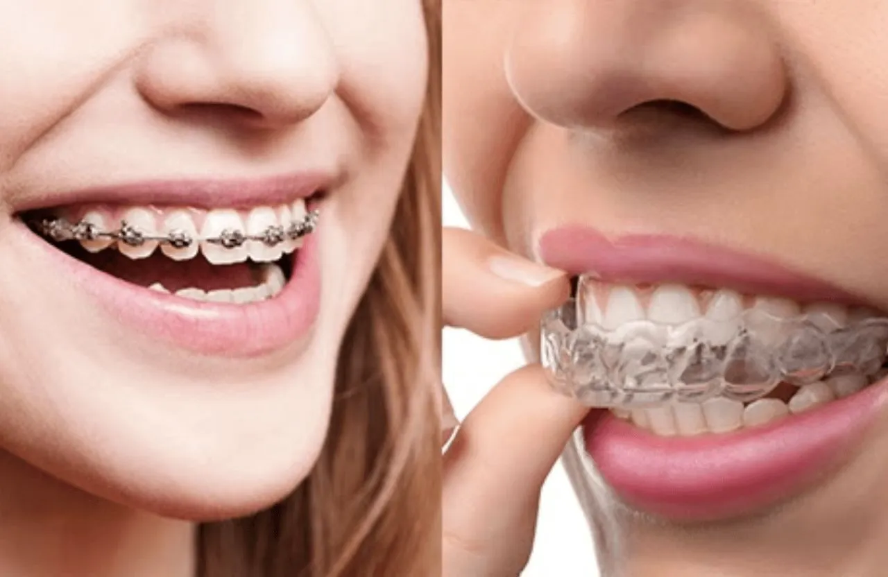 Aligners And Braces