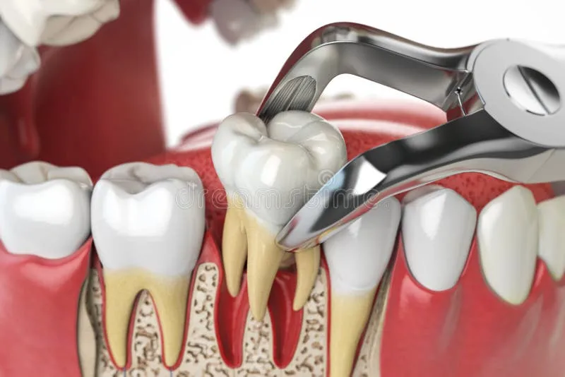 Painless Tooth Removal