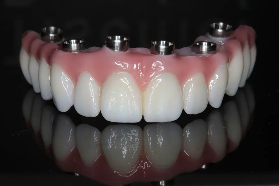 Implant Full Mouth