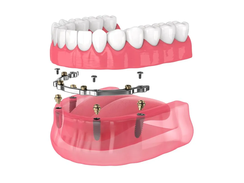 Fixed And Removable Dentures