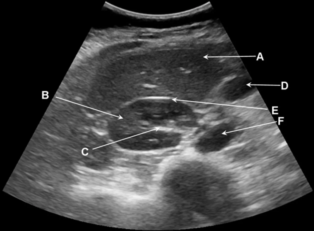 UPPER ABDOMEN