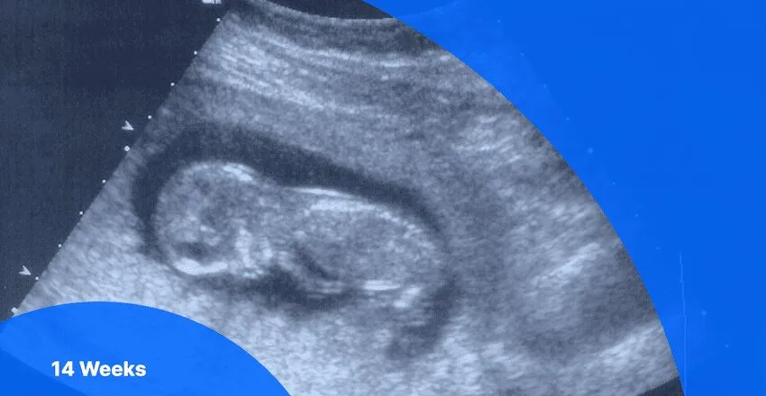 LEVEL - ||, ANOMALY SCAN (18-20 WKS)