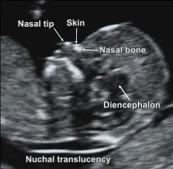 11 TO 14 WEEKS (NT/NB)