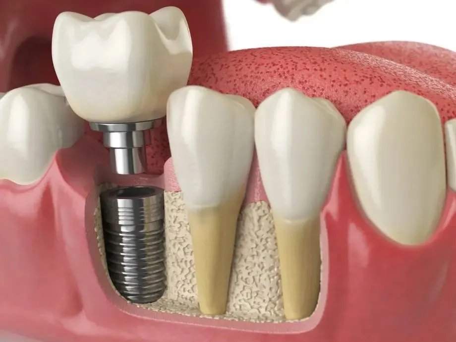 Implant Surgery