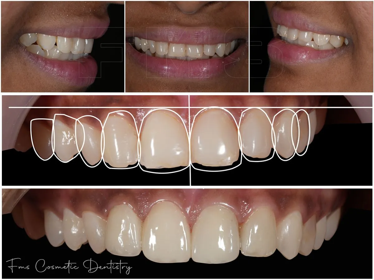 Smile Designing And Cosmetic Dentistry