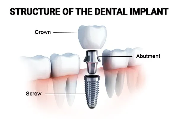 Implant