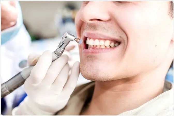 Teeth Cleaning And Polishing