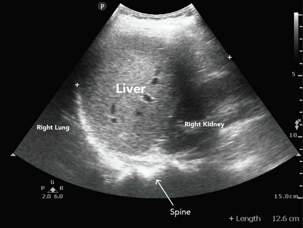 WHOLE ABDOMEN