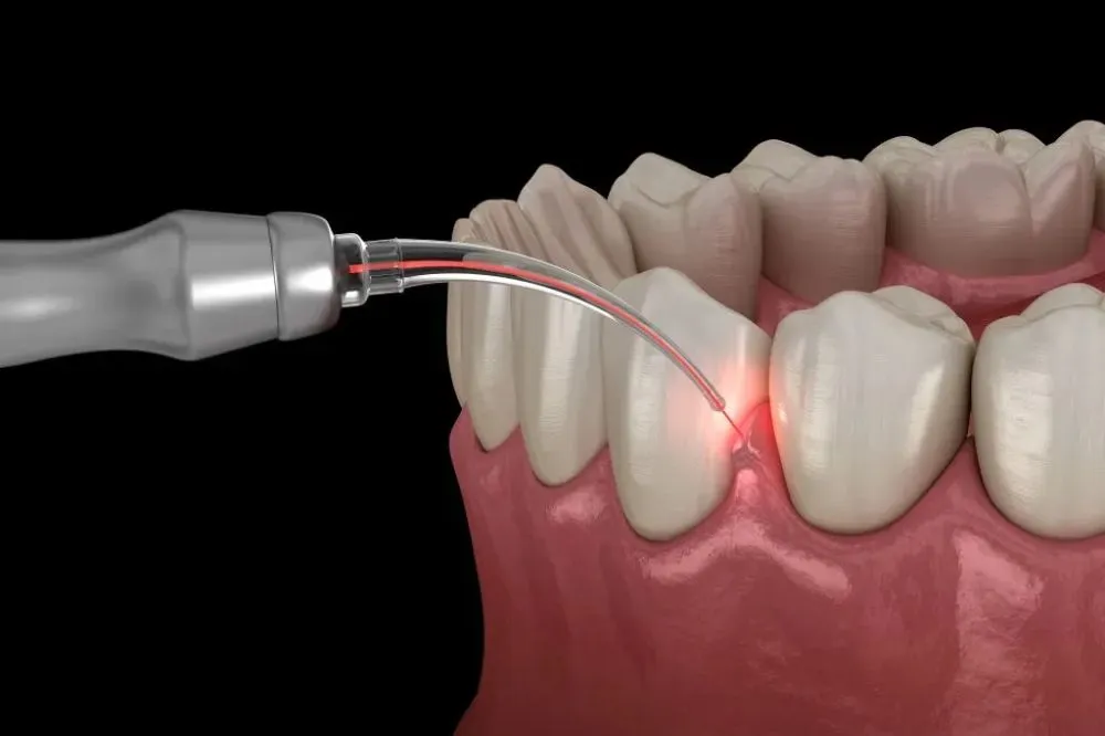 Gum Surgery