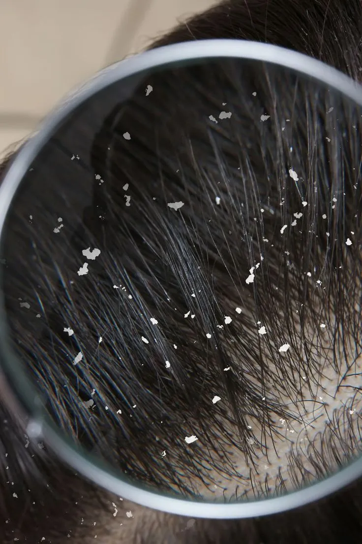 Schwarzkopf Anti-Dandruff Treatment