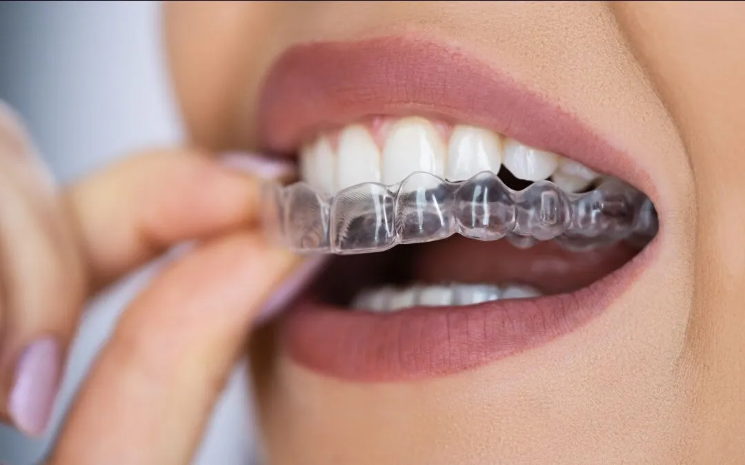 Aligners And Braces Treatment