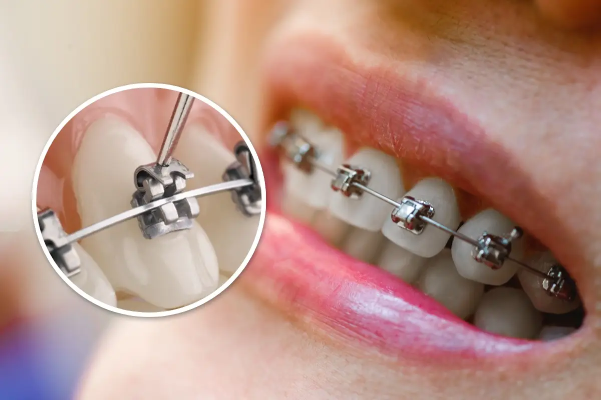 Self ligating Orthodontic bracer Treatment