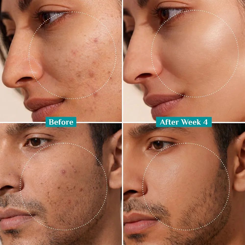 Pilgrim 10% Niacinamide Face Serum for Acne Marks & Glass Skin Glow - 
with Kojic Acid & Korean Rice Water, Fades Dark Spots, Boosts Glow, Minimizes Pores, Controls Excess Oil, Sensitive Skin Safe view 4