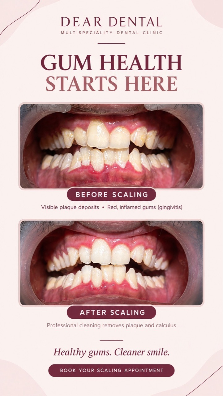 Gum Scaling Treatment