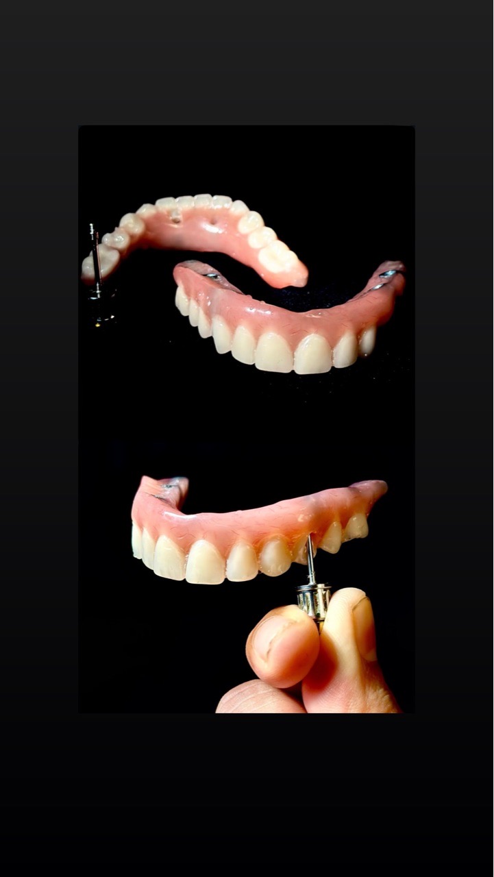 Full Mouth Rehabilitation