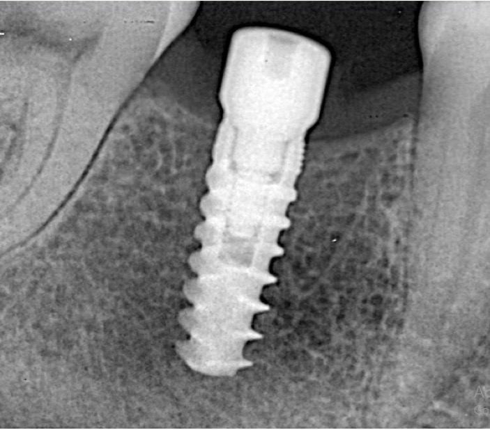 Dental Implant